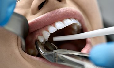 Root canal patient in Chicago getting a tooth extraction