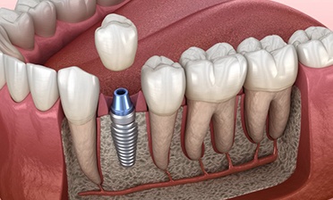 single dental implant fusing to the jawbone 