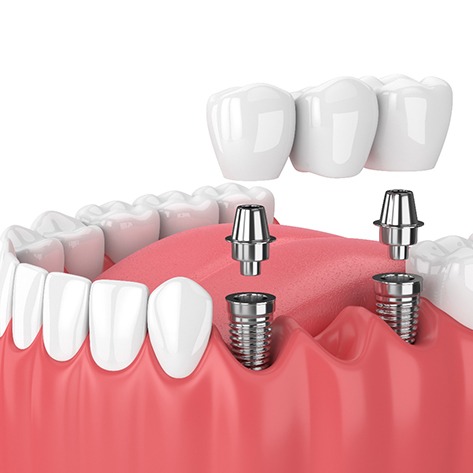 3D graphic of implant bridge 