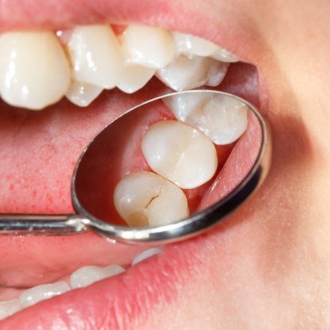 Dentist examining smile after metal free dental crown placement