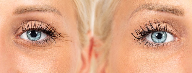 Before and after dermal fillers in West Loop Chicago