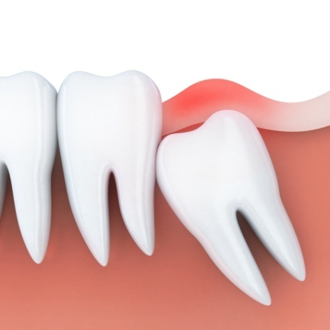 Aniamted smile with impacted wisdom tooth in need of extraction