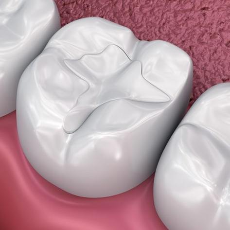 a 3 D digital illustration of a tooth colored filling