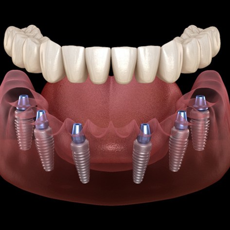Illustration of implant dentures in Chicago, IL for lower arch