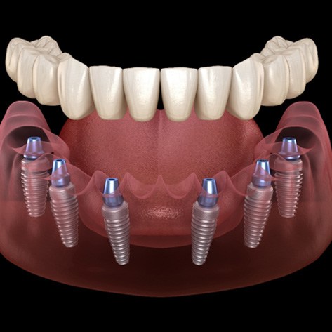 Illustration of implant dentures in West Loop Chicago for lower arch