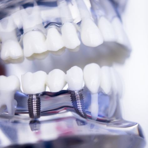 Can Fillings Look Like Your Natural Teeth? - TruCare Dentistry