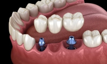 Animated smile during dental implant supported fixed bridge placement