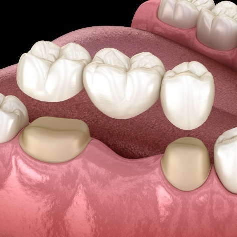 Animated dental bridge used to replace missing teeth in smile