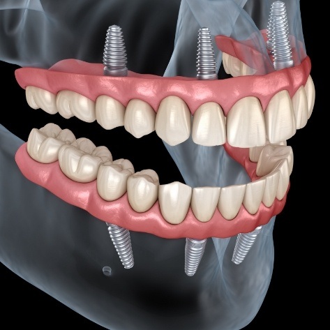 Animated smile with full set of dental implant supported dentures