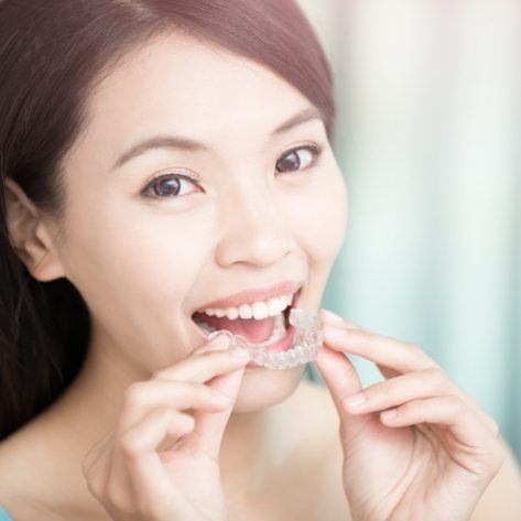 Woman placing an Invisalign clear braces tray