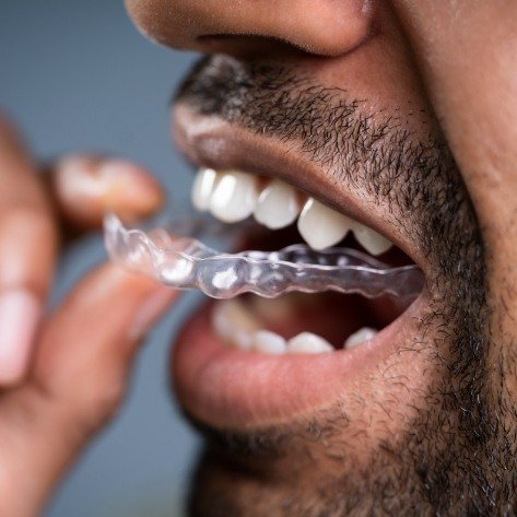 Patient placing Dandy Dental clear aligner