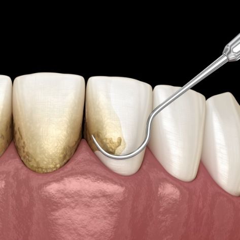 Animated smile during scaling and root planing periodontal therapy