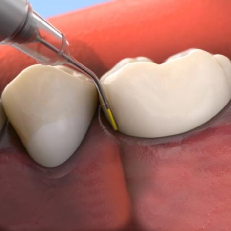 Animated smile during Arestin antibiotic thearpy