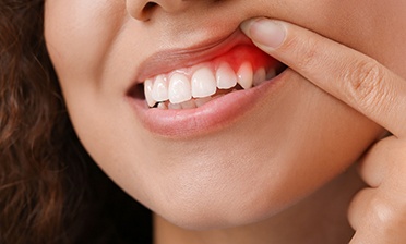 a woman holding up her lip to show her inflamed gums