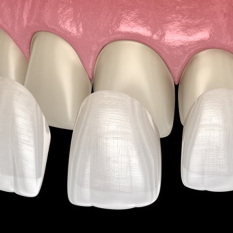 veneers being placed over the teeth 