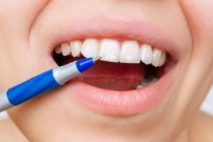 Closeup of teeth with pen pointing to white spots