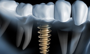 single dental implant in the jawbone 